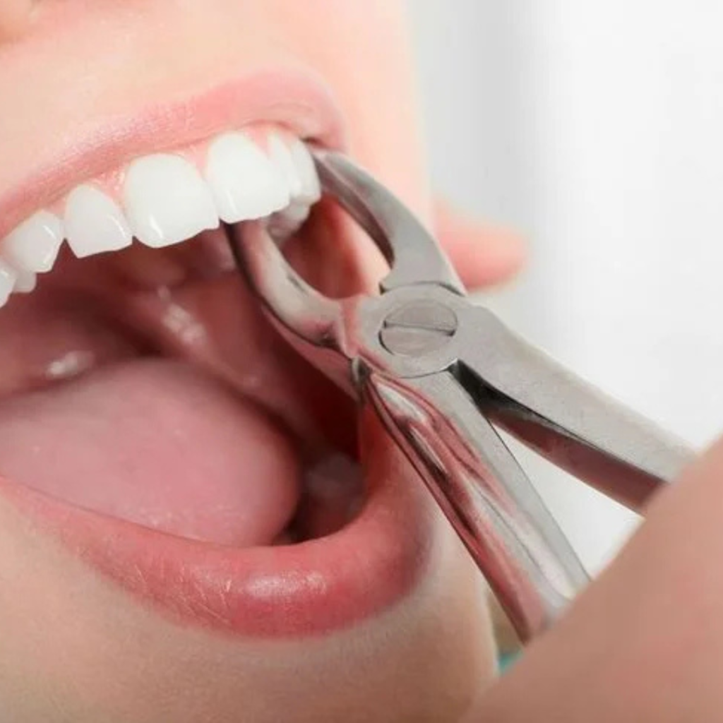Best Painless Tooth Extraction in Rajendra Nagar
