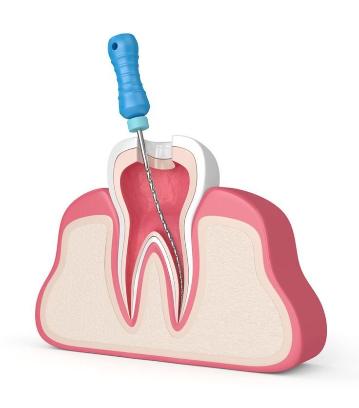 Best Root Canal Treatment in Rajendra Nagar