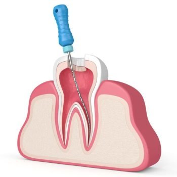 Root canal and endodontics in Tijuana _ The Dental District